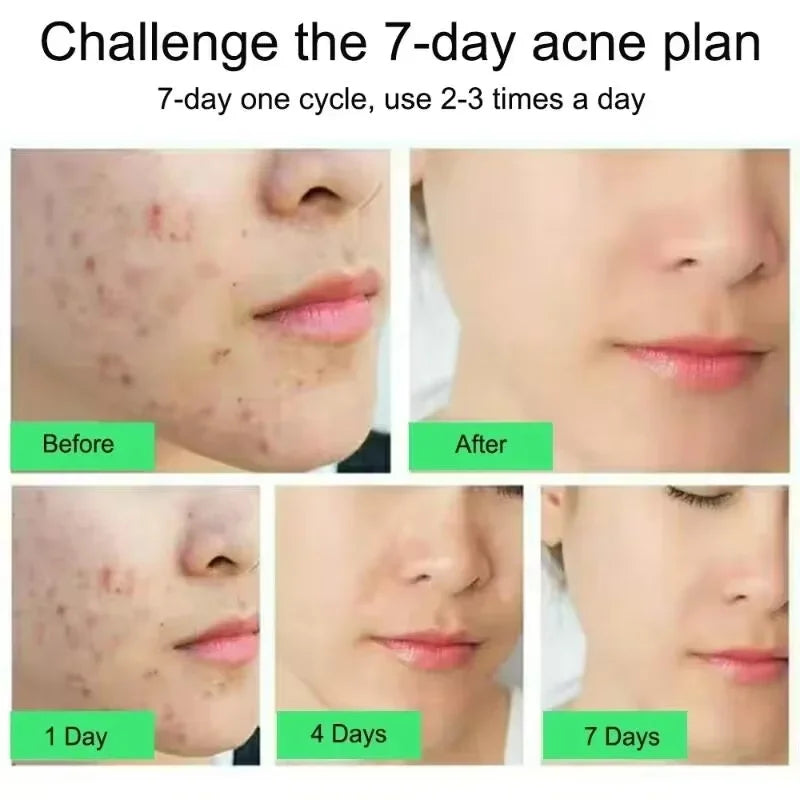 Salicylic Acid Acne Treatment