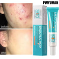 Salicylic Acid Acne Treatment