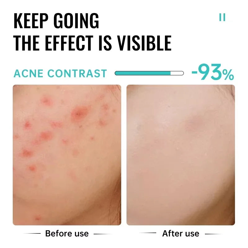 Salicylic Acid Acne Treatment