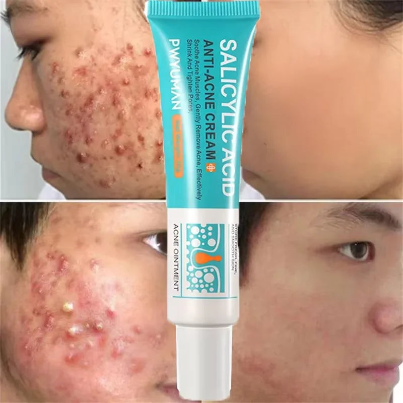 Salicylic Acid Acne Treatment